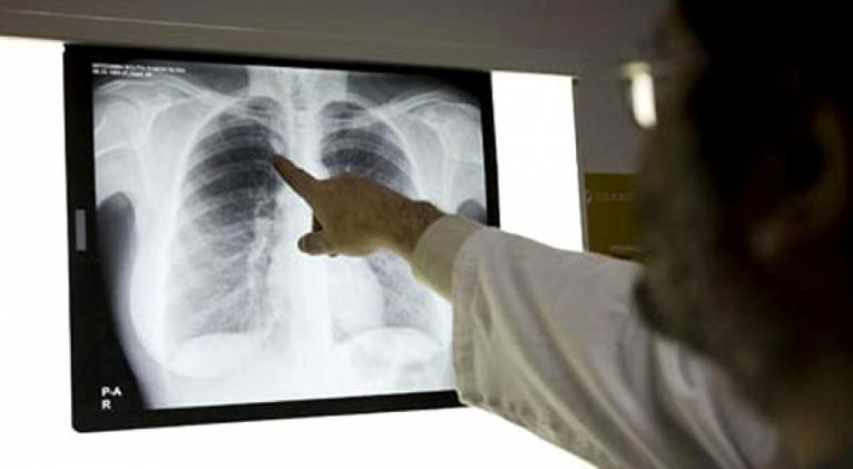 tuberculosis cuba